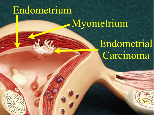 endometrial-carcinoma